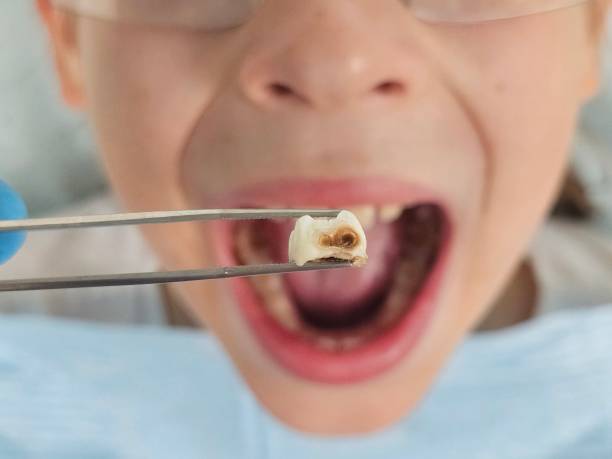 Best Emergency Wisdom Tooth Extraction in Lincoln Park, MI